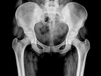 Osteoporosis: qué debemos comer para prevenirla