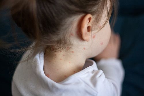 Los pediatras advierten del aumento de la incidencia y de brotes localizados de sarampión